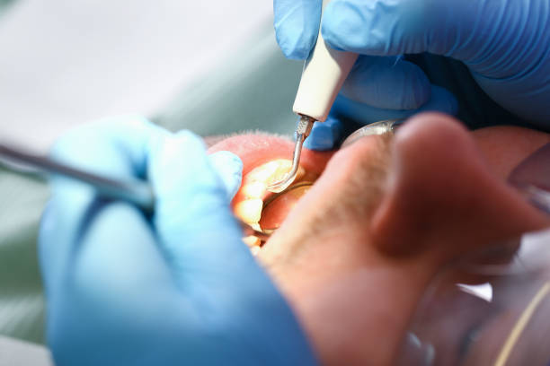 Best Knocked-Out Tooth (Avulsed Tooth) Treatment in Ames, IA